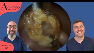 SKIN RING REMOVAL & 2 MORE EAR WAX REMOVALS- EP849