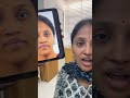 Post redo rhinoplasty results