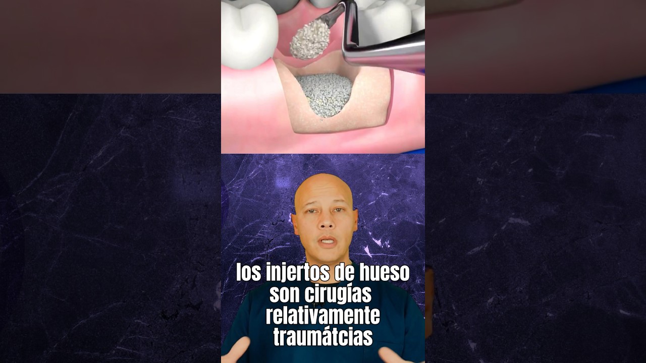 Los Injertos de Hueso funcionan así