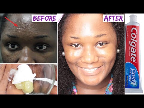 ? I Applied Toothpaste And Vaseline On My Face And See What Happened The Next Day!