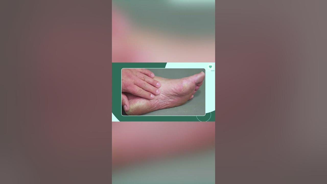 What Skin Conditions Can Look Like Psoriasis