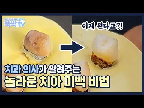 콜라에 착색된 치아를 치아 미백 치료해 보았습니다