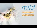Mild Procedure Animation | Lumbar Spinal Stenosis (LSS) Treatment