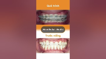 Hành trình LỘT XÁC nhờ niềng răng của Minh Hùng