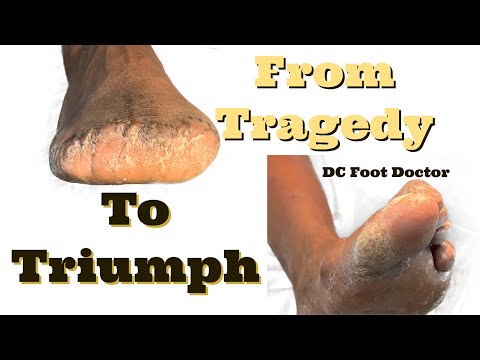 From Tragedy to Triumph: Foot Care After Amputation