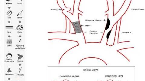 How can I manage the vascular cartography tools - Carotid and Vertebral?