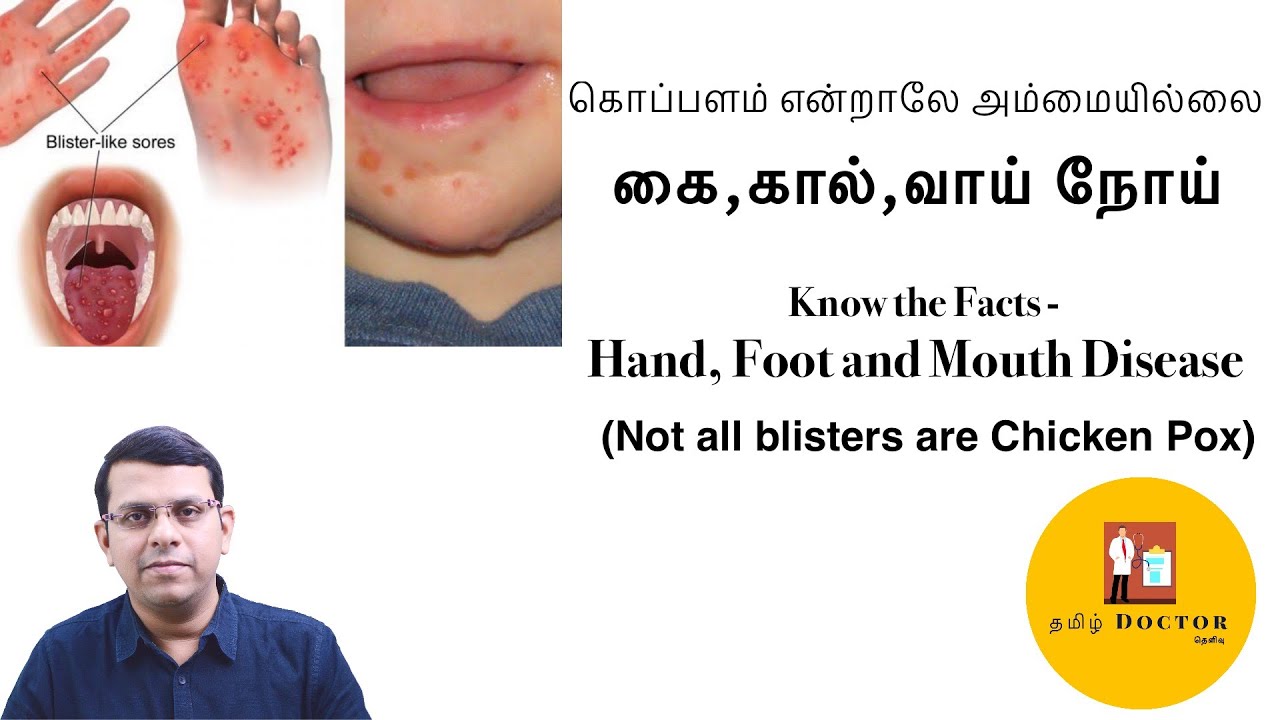 கொப்பளம் என்றாலே அம்மையில்லை கை,கால்,வாய் நோய் Hand,Foot and Mouth