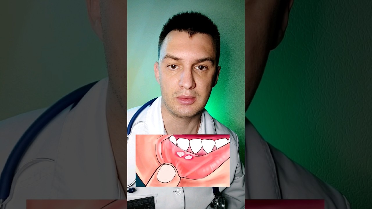 Лечим стоматит