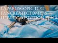 Lap dist pancreatectomy, &amp; hepatic resection S7,S4a / Лап дист резекция ПЖ, резекция печени S7, S4a