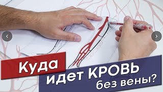 Куда пойдет кровь после удаления варикоза?