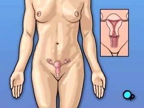 on.fb.me - NEW facebook page - it's cool! SEE MORE VIDEOS @ PreOp.com Patient Education @ 617-379-1582 INFO Your gynecologist has recommended that you undergo surgery to remove vaginal fibroids. But what does that actually mean? The uterus is part of a woman's reproductive system - it's the organ that contains and protects a growing fetus during pregnancy. Fibroids are non-cancerous tumors that grow from the inner or outer wall of the uterus, and may be removed via the vaginal passage. They are quite common - as many as 20% of women over 30 will develop fibroids sometime during their lifetimes. In most cases fibroids do not cause any discomfort and are never detected. Occasionally, however, fibroid tumors can cause problems. Complications from fibroid growth can include * Pressure on the urinary system. * Pressure on the intestines. * Interference with the reproductive system * Or infection. * Fibroids that lead to heavy vaginal bleeding lead to anemia and iron deficiency. Because these tumors can grow to be very large, surgery is usually recommended in order to restore health and to protect the uterus. A small surgery that can be performed transvaginally or laparoscopically.