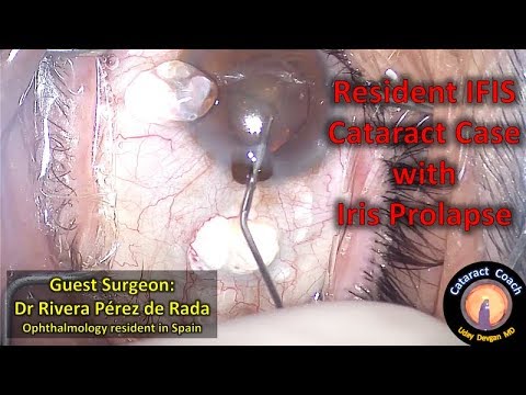 Resident surgeon in training performs cataract surgery in an IFIS case with iris prolapse