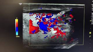 ULTRASOUND acute epididymoorchitis