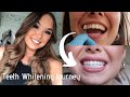 My Teeth Whitening Journey | during COVID | Zoom Nite White