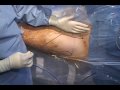 Portal Placement in Hip Arthroscopy