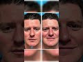 IG-Ready Confidence 👃✨ | Dr. Becker’s Male Rhinoplasty Case