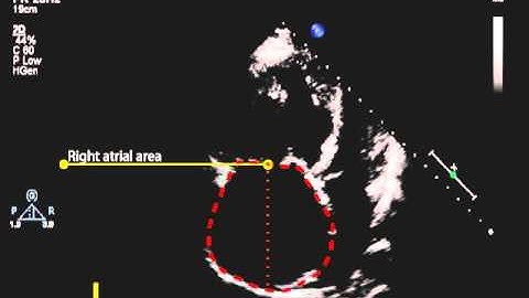 18. Measurement of right atrial volume