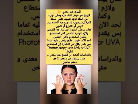لايوجد علاج يقضي على بهاق بشكل كامل