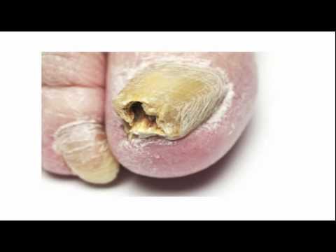 Toenail Fungus Treatment - A Fast Cure For Toenail Fungus You Must Try