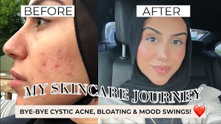 My Skincare Journey | PCOS, Cystic Acne, Gut Health & Healing my Inner Self 🌱✨ ☀️