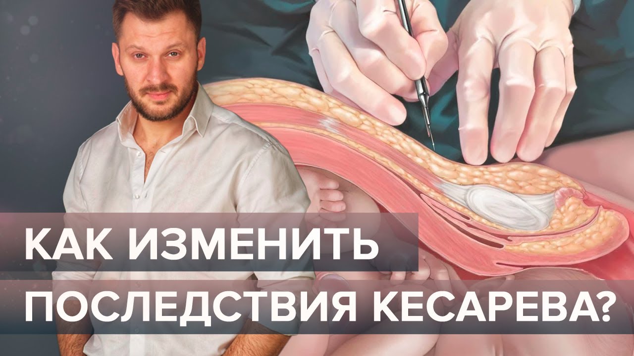 Кесарево сечение влияет на развитие ребенка! Чем отличаются дети ...