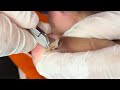 Ep_6581 Ingrown toenail removal 👣 ต้องการโล่งแบบนี้..ถึงมาหาพี่ครับ  😄 (clip from Thailand)