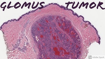 Glomus Tumor: 5-Minute Pathology Pearls