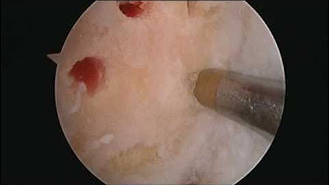 Knee Microfracture