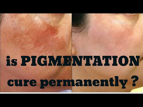 Is there a permanent solution for pigmentation? Why Does Skin Pigmentation Occur? Skin pigmentation