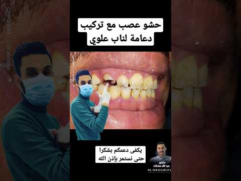 حشو عصب مع تركيب دعامة أسنان لناب علوي دكتور عبدالله سلطان الهنداوي   تابعني