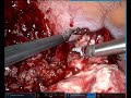 Ruptured appendix with abscess - Xi with 8mm stapler