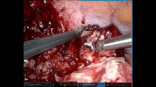 Ruptured appendix with abscess - Xi with 8mm stapler