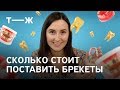 Брекеты: сколько стоит установка, как сэкономить