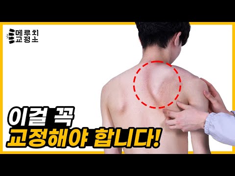 이건 꼭 교정해야 돼!!ㅣ메루치교정소(익상증후군)