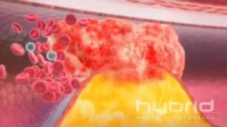Understanding High Blood Pressure
