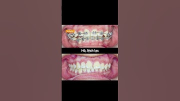 Cận cảnh sự thay đổi của răng hô, chen chúc sau khi niềng