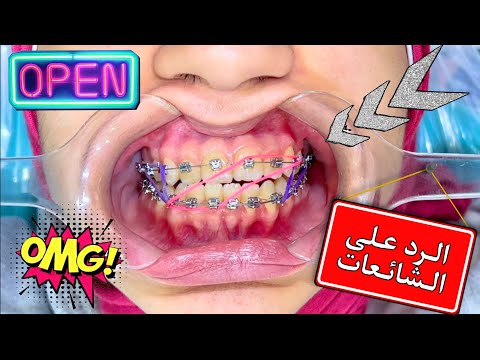علاج العضه المعكوسة كلاس 3