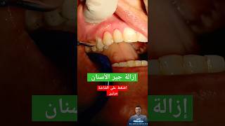 إزالة جير الأسنان عند الطبيب|| أسباب رائحة الفم الكريهة #dr_abdullah_sultan_dentist #dentist #소아치과