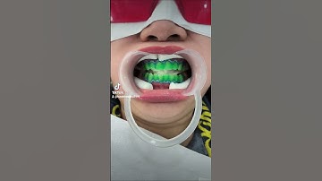 Tẩy trắng răng tại nha khoa sẽ như thế nào và cái kết #shorts #tẩytrắngrăng #nhakhoa #dental