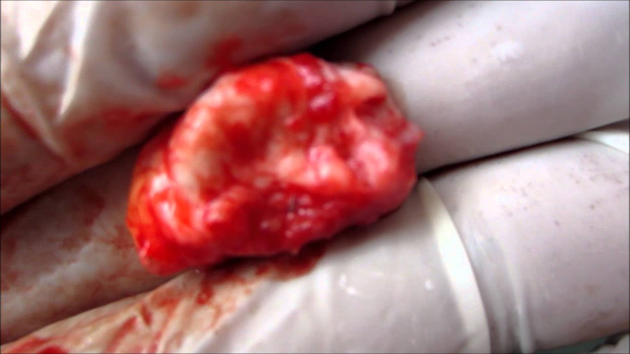 pilar cysts images #10