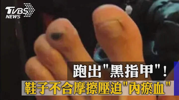 跑出「黑指甲」！　鞋子不合摩擦壓迫「內瘀血」 - 天天要聞