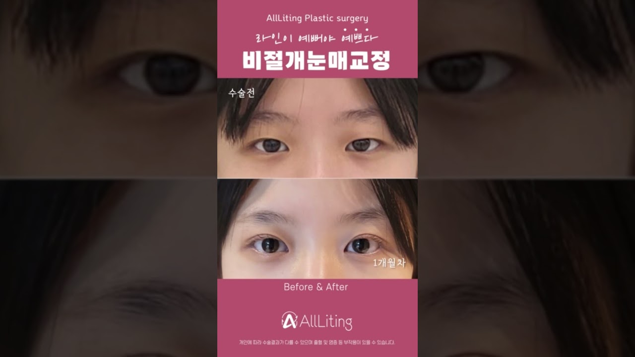 [奧麗婷整形外科診所] 稚嫩的雙眼也能透過 #無切開提眼肌矯正 變身清純🥰 #提眼肌矯正 #雙眼皮手術 #雙眼皮手術心得 #眼瞼下垂 #提眼肌矯正心得 #江南 #江南整形外科 #整形外科