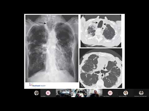 Video: Bronchiectasis: En Växande Global Epidemi