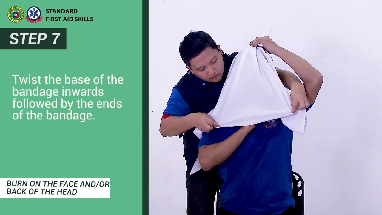 BURN ON THE FACE AND OR BACK OF THE HEAD