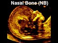 Nasal bone assessment and absent nasal bone at 11-13 weeks