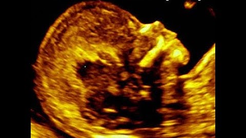 Nasal bone assessment and absent nasal bone at 11-13 weeks