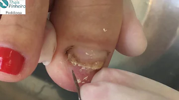 Quanto custa o tratamento a laser para micose de unha?