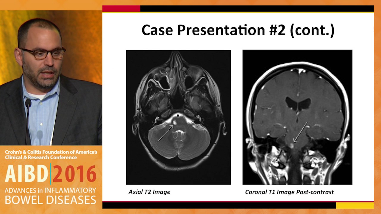 Neurologic, rheumatologic, and optic complications related to immunomodulators and biologic