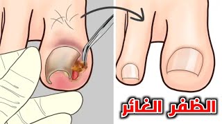 ماهو الظفر الغائر وكيف يتم علاجة (الاظافر المغروسة في اللحم)_ What is an ingrown toenail