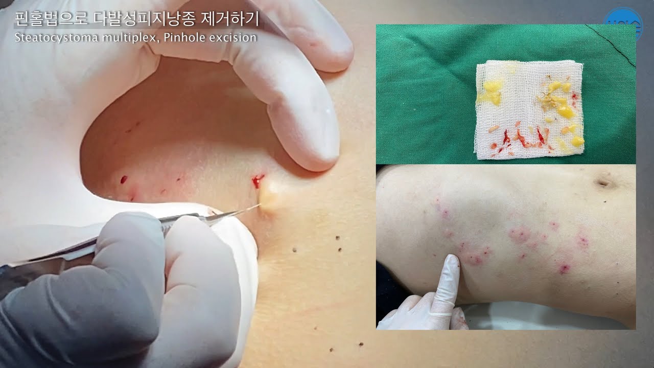 Steatocystoma Multiplex, Pinhole Excision 다발성피지낭종 핀홀법 - Youtube